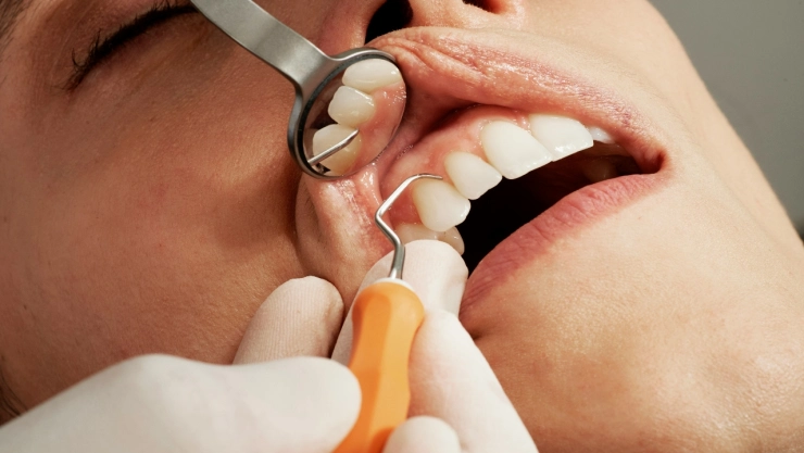 UNAM-Las-infecciones-dentales-no-tratadas-pueden-llevar-a-la-muerte