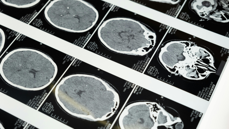 Ictus enfermedad vascular cerebral