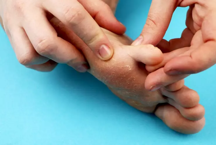 Los hongos pueden hacerle mucho daño a la salud de nuestros pies: es fundamental controlarlos periódicamente.