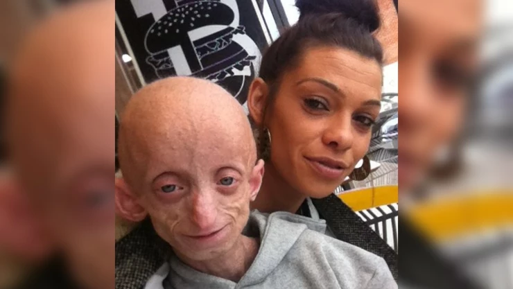 Ashanti Smith enfermedad benjamin button.jpg