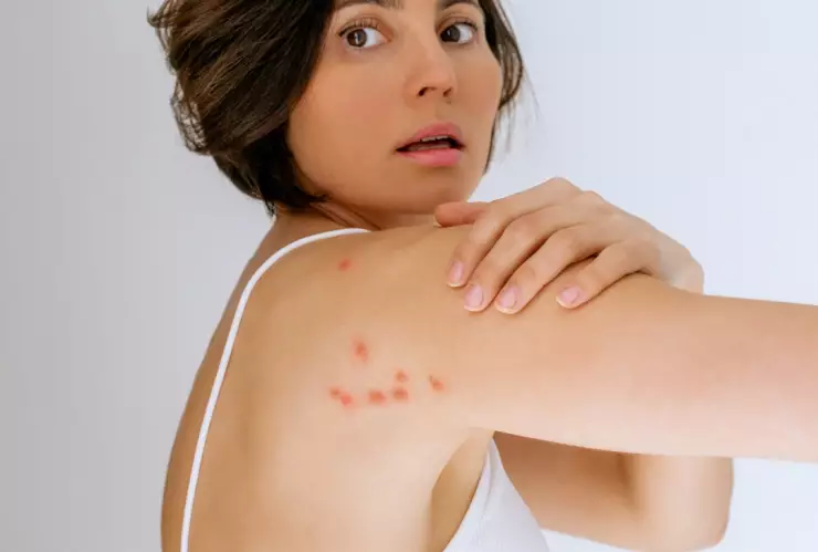 3 trucos para que la picadura de chinche no cause comezón