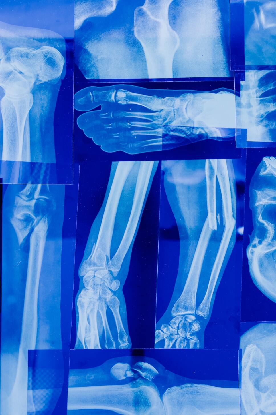 preguntas de la osteoporosis
