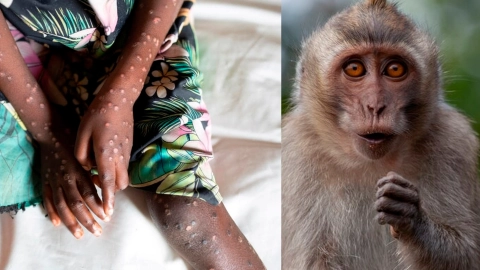 Viruela símica Chiapas