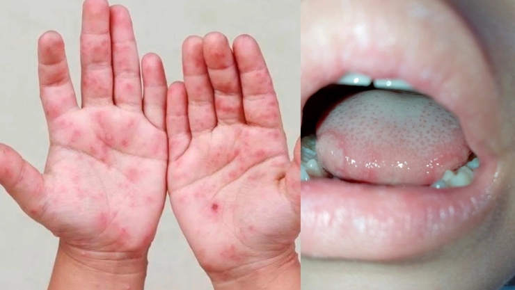 Coxsackie en niños: qué es, cómo se transmite, síntomas y medidas para evitar el contagio