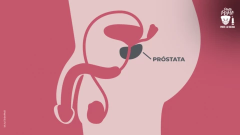 Cáncer-de-próstata (1).jpg