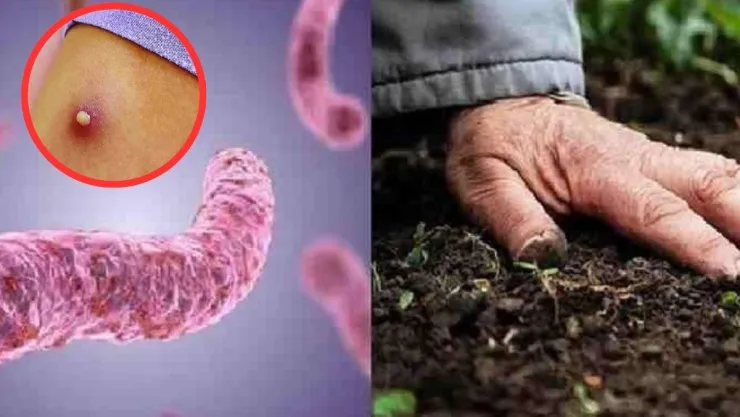 melioidosis
