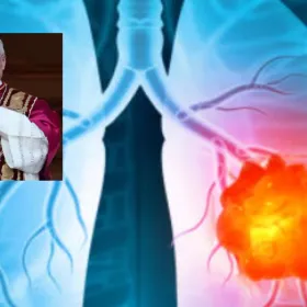 Cáncer de pulmón: causas y factores de riesgo tras el caso del papa León XIV