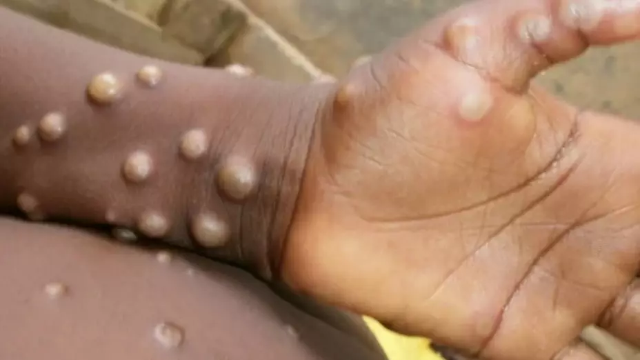 OMS declara a la viruela del mono como emergencia internacional