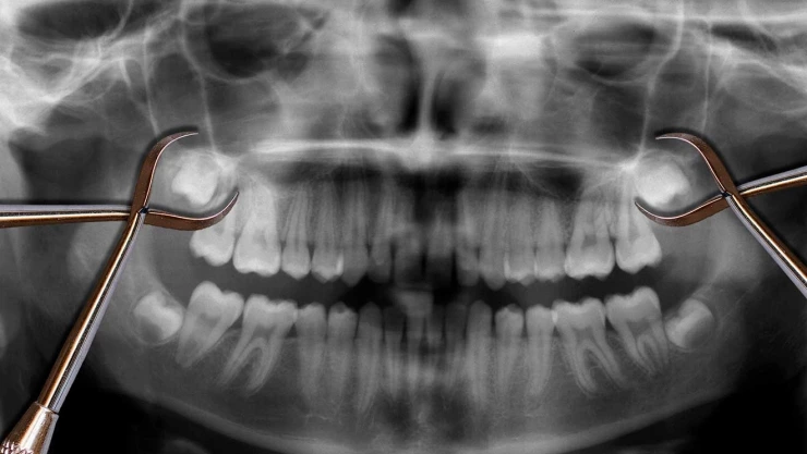 UNAM-No-extraer-muelas-del-juicio-puede-causar-quistes-y-tumores-en-mandíbula