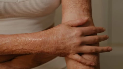 La Regla de los nueve de Wallace: Estimación rápida de la SCTQ y clasificación de quemaduras en adultos.