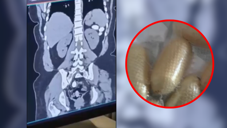 rayos x del cuerpo de la mujer sudamericana (izquierda) y cápsulas de cocaína dentro de un círculo rojo