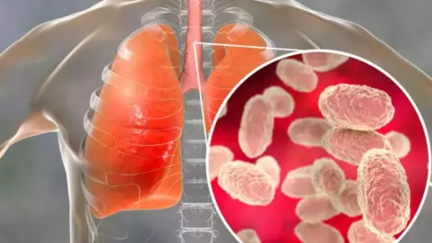 ¿Qué es la tos ferina y cuáles son los síntomas de la enfermedad que afecta a los niño?