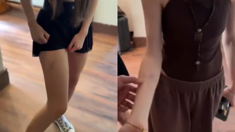 Esposa-de-Alfredo-Valenzuela-muestra-marcas-de-los-golpes-que-le-dieron-los-asaltantes