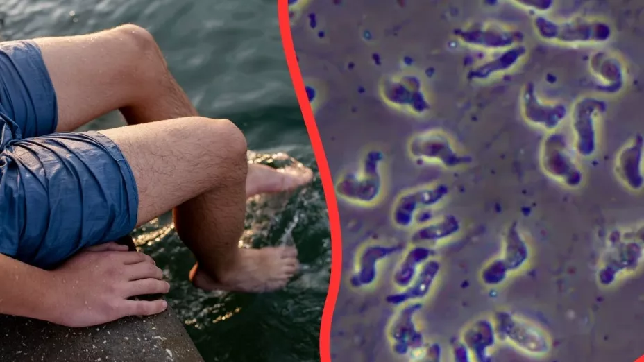 ¿Amiba comecerebros? Estos son los síntomas de la enfermedad