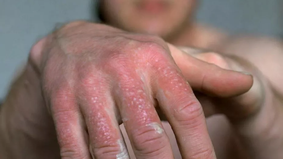 ¿Se disparan casos de sífilis en Guanajuato en 2025 Esto es lo que sabemos.jpg