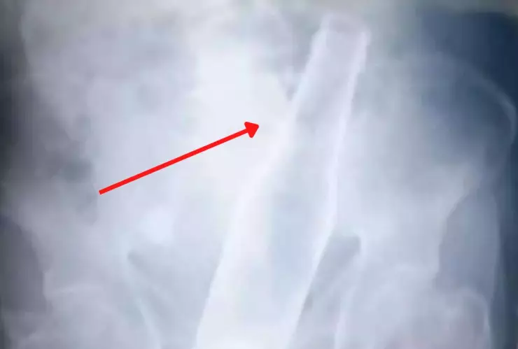 Fue al hospital por dolor; hallaron una botella atorada en el colon