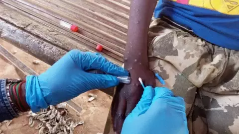 Reportan hasta 7 casos de VIRUELA DEL MONO en la Península de Yucatán