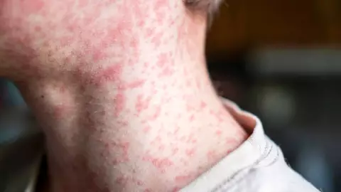 Chihuahua lidera casos de sarampión