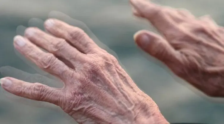 parkinson