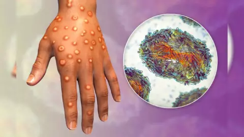 Viruela del mono en México