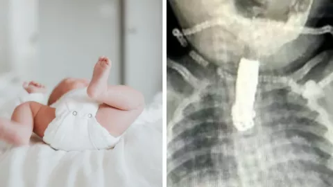 FOTOS Una bebé se traga un cortauñas y se le atora en la garganta