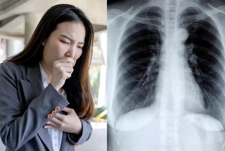 Mujer tose tan fuerte que se rompe cuatro costillas