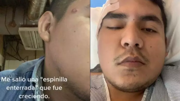 VIDEO Hombre descubre que espinilla en su cara es un tumor.jpg