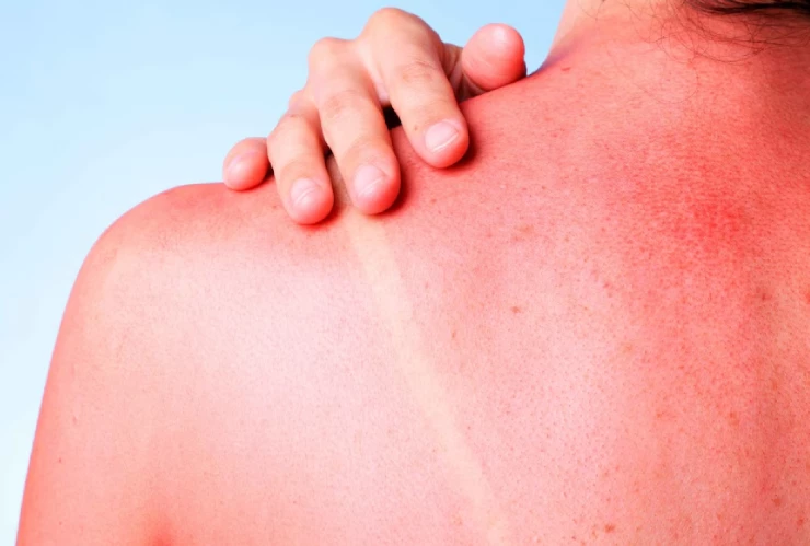 radiación solar extrema.jpg