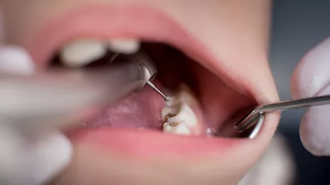 niños caries