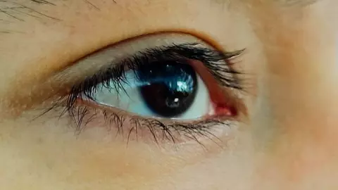 casos de conjuntivitis en yucatan