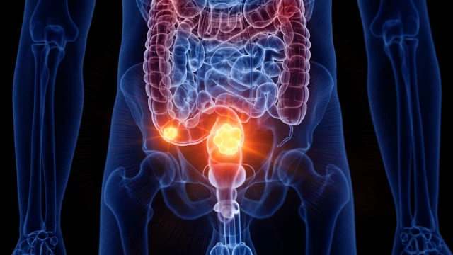 Cáncer de colón