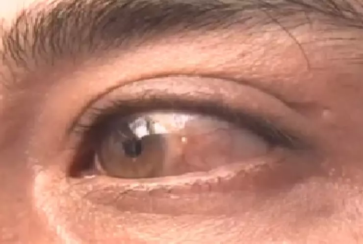 El estrés visual puede provocar pérdida de visión