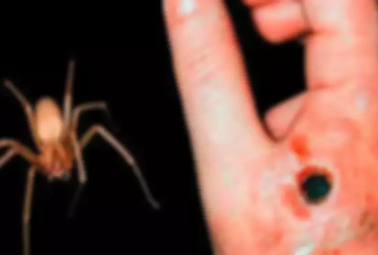 FOTOS_ ¿Cómo se ve la necrosis por mordedura de araña violinista?