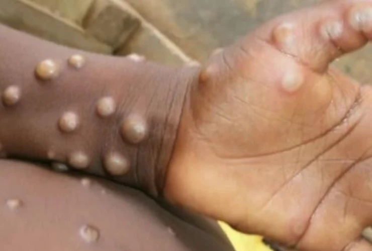 La OMS declara emergencia sanitaria por viruela del mono