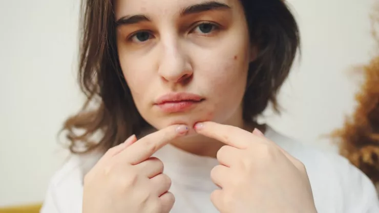 Este es el maquillaje que puedes usar para la piel con acné y evitar dañarla