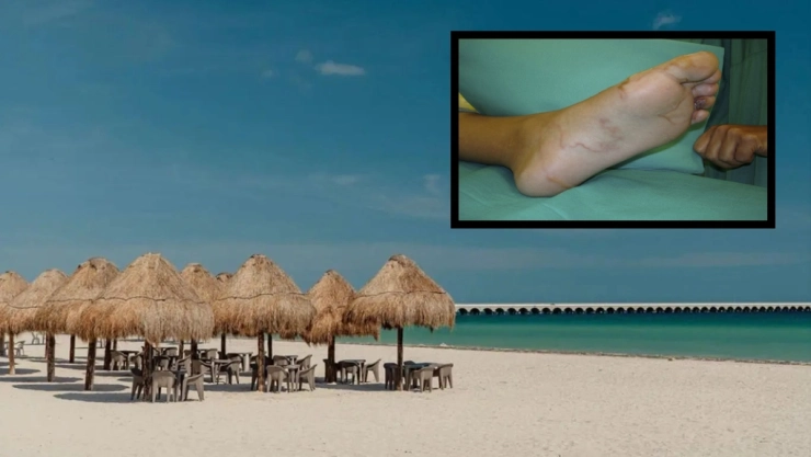 ¿Qué es la larva migrans cutánea y por qué podría estar presente en las playas de Yucatán?
