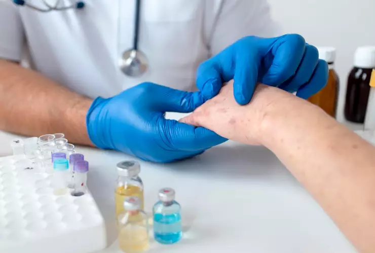 Incrementan casos de sarampión, alerta la OPS