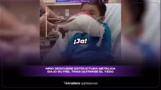 Niño descubre una estructura metálica bajo su piel al quitarse el yeso