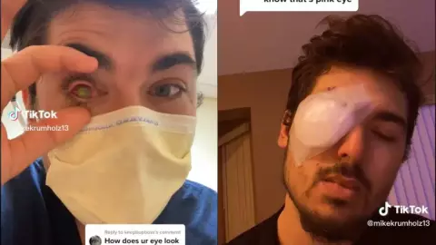 Se queda ciego por dormir con lentes de contacto.