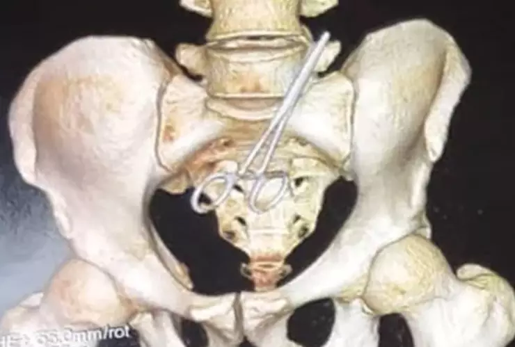 Va al doctor por dolor y hallan tijeras quirúrgicas en su intestino