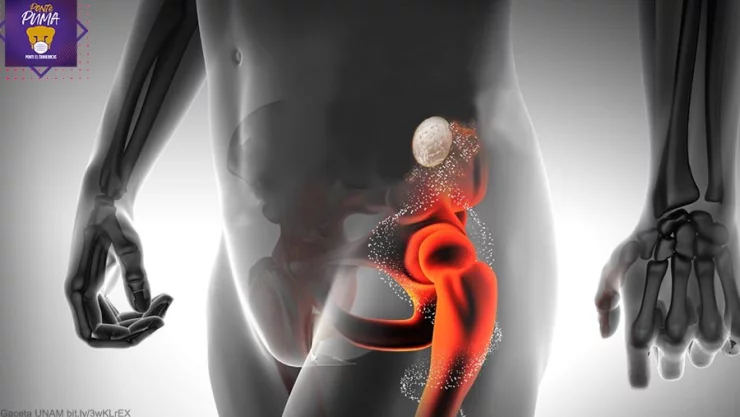 osteoporosis-unam-parche