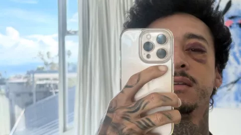 Nyjah Huston mostr&oacute; c&oacute;mo qued&oacute; tras el accidente