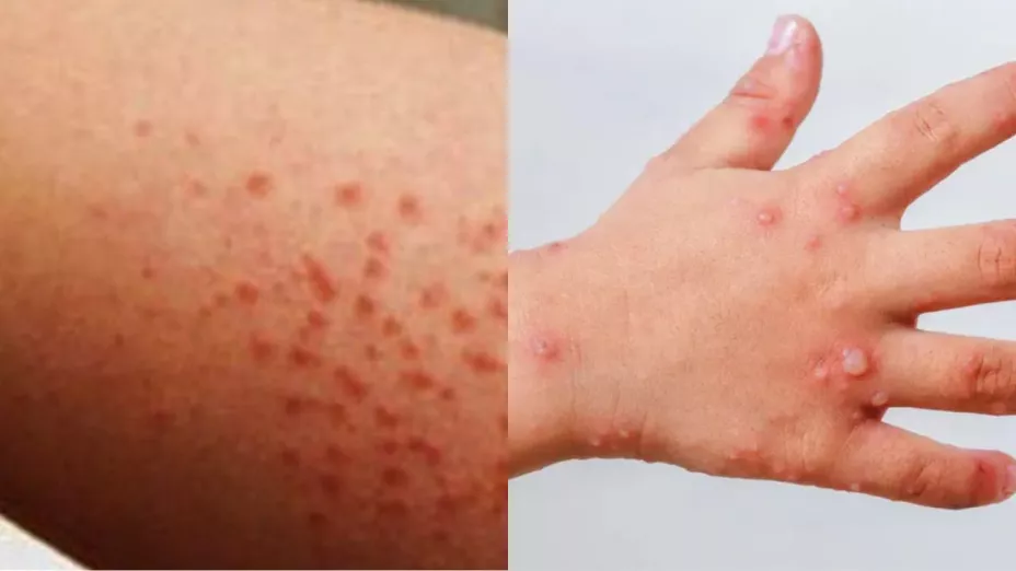 Suman más de 400 estudiantes contagiados del virus Coxsackie y más estados en México suspenden clases