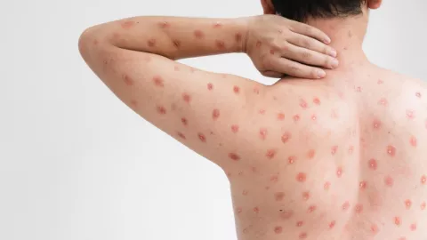 Viruela de mono: Síntomas de la cepa que mantiene en alerta a la OMS por su expansión