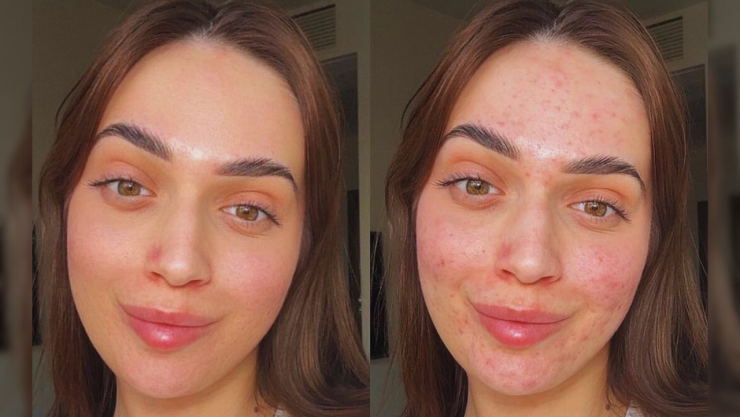 Dermatólogos dan soncejos para tratar granos de la cara