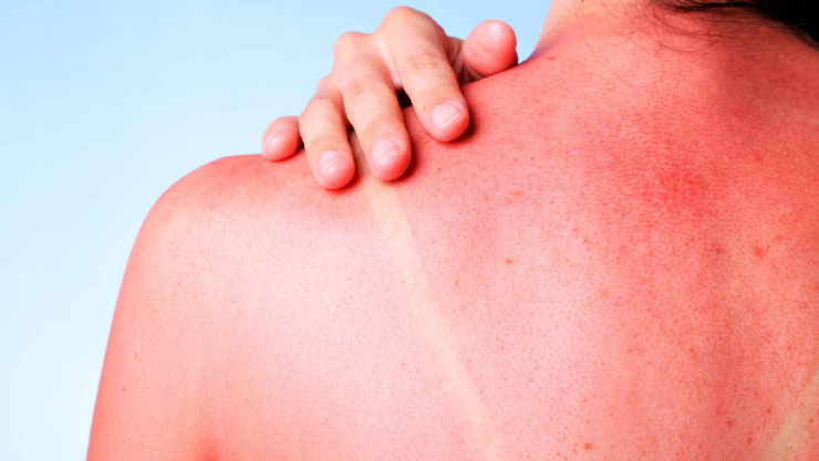 radiación solar extrema.jpg