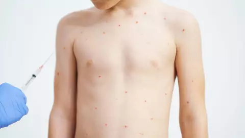 sarampión en Cuauhtémoc