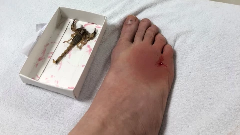 Joven fue picado dos veces por un alacarán mientras dormía: Remedios para mantenerlos lejos de la cama