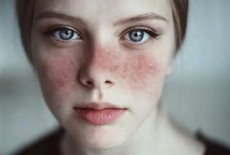 Lupus