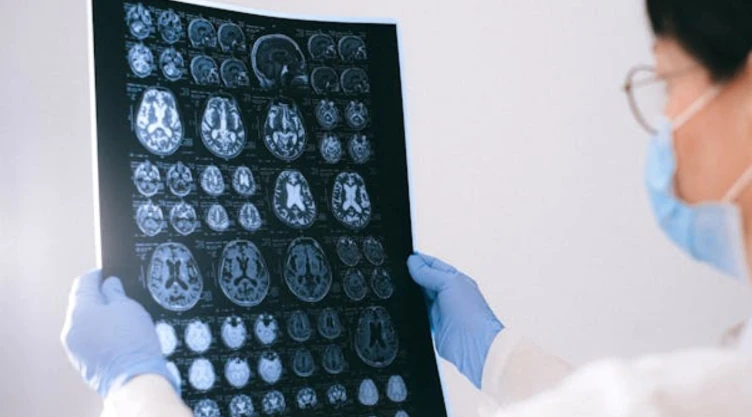 Científicos observan el Alzheimer en tejido cerebral y en tiempo real, ¿qué significa?